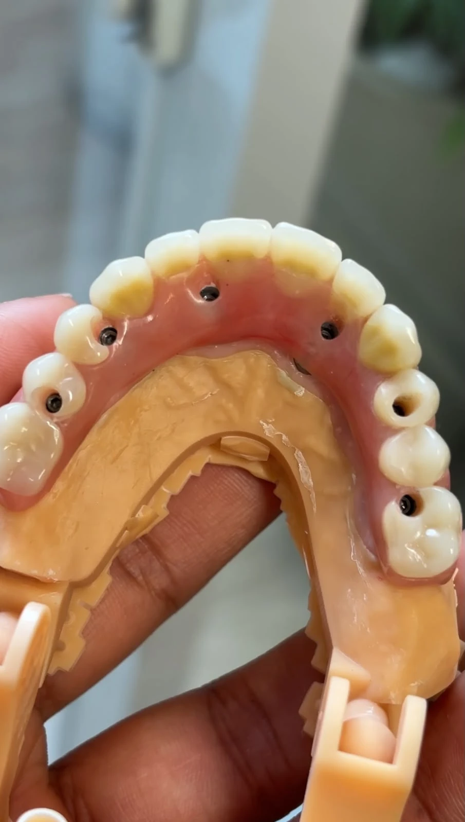 Implantes Protocolo